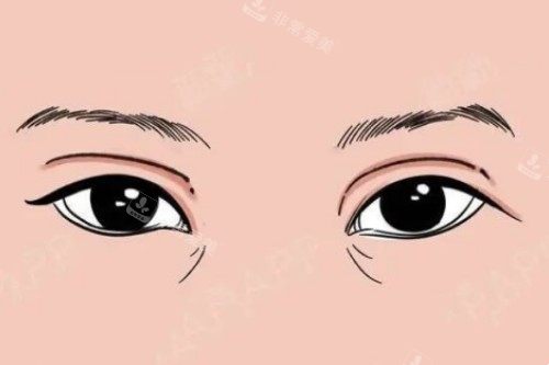 双眼皮失败卡通图