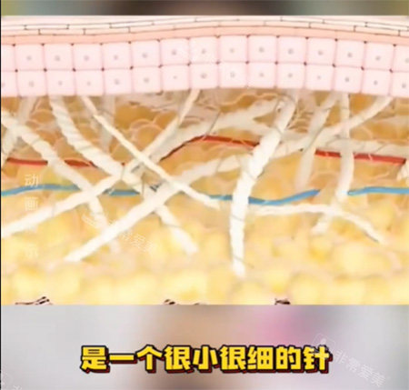 私密紧致针好不好.jpg