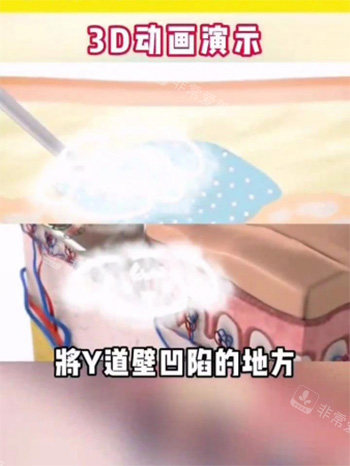 紧缩针注射阴道动画图.jpg