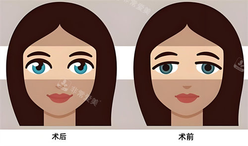 双眼皮术后术前对比动画图.jpg