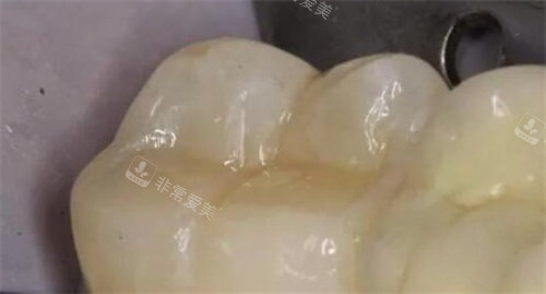 3M树脂补牙.jpg