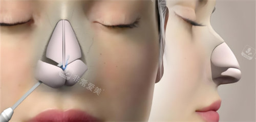 鼻综合鼻骨动画.jpg