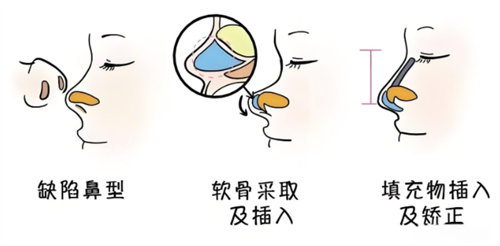 鼻综合手术过程动画.jpg