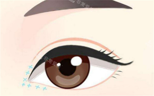 眼综合手术后眼部的样子.jpg
