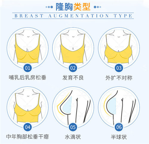 假体隆胸适应症.jpg