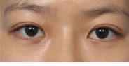 半岛眼整形外科-别人说我的眼睛像韩国明星金泰熙