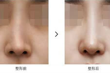 韩国隆鼻修复方法有哪些