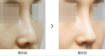 鼻头变低修复对比图