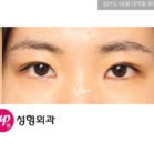 韩国伊芝美整形-双眼皮整形对比日记