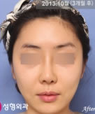 韩国伊芝美整形-歪脸矫正对比日记