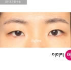韩国伊芝美整形-双眼皮整形对比日记