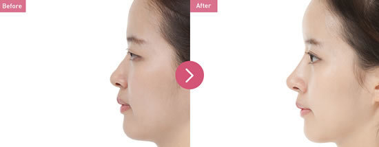 韩国无需化妆的华丽鼻整形，你造吗?