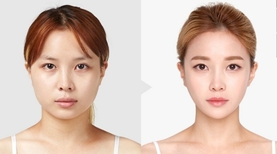 韩国TL整形医院瘦脸对比案例