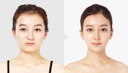 韩国瘦脸前后对比案例