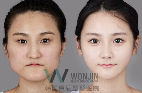 韩国改脸型手术
