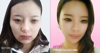 韩国TL整形改脸型案例