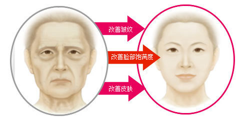 韩国面部提升埋线童颜术