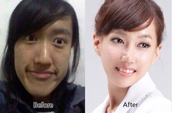 韩国faceline整形改脸型案例