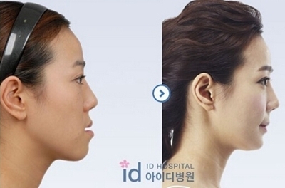 韩国ID整形突嘴手术
