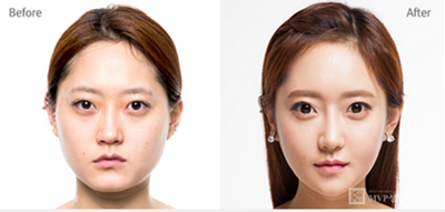 韩国mvp整形医院瘦脸对比案例