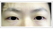 韩国eve整形-韩国eve整形外科双眼皮手术日记对比