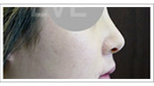韩国eve整形-韩国eve整形外科隆鼻手术日记对比图