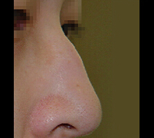 鼻子整形对比案例