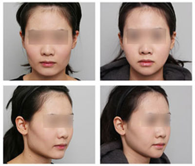 韩国JK整形外科面部轮廓