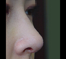 鼻子整形对比案例