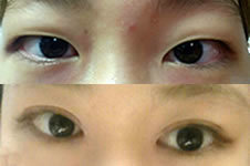 （多图）留学生在韩国贝缇莱茵做双眼皮整形经历
