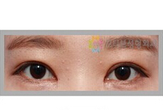 韩国MOTIVE整形-双眼皮整形对比日记