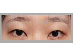 韩国MOTIVE整形-双眼皮整形对比日记
