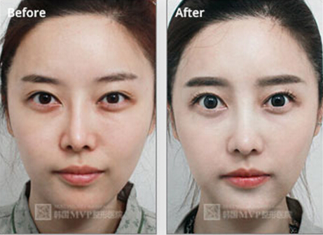 韩国鼻子修复都有哪些好的医院