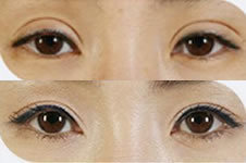 韩国双眼皮修复出色的医院