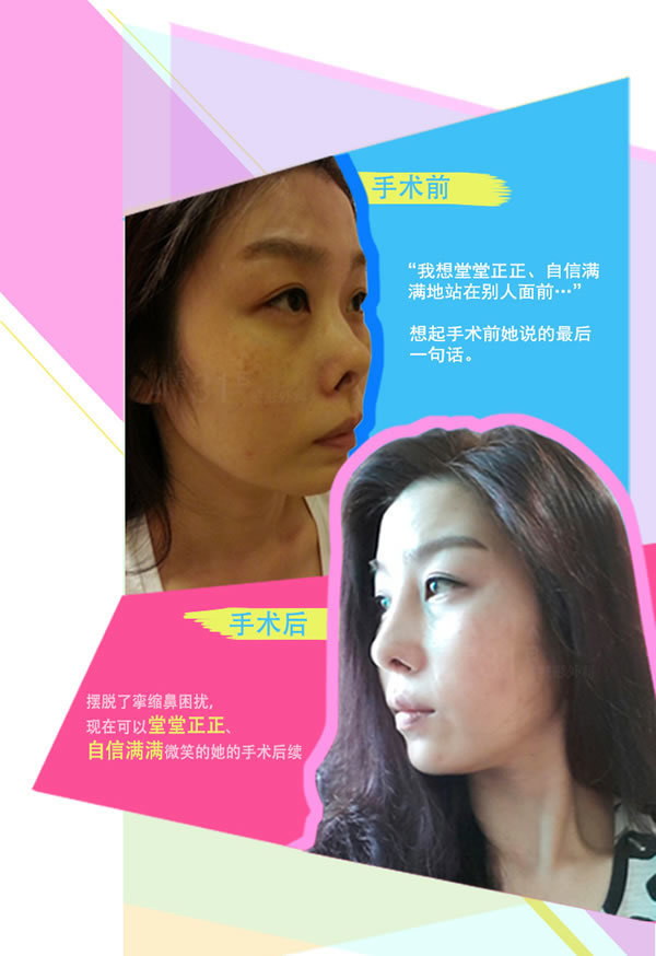 分享：女子赴韩整形鼻子修复手术故事