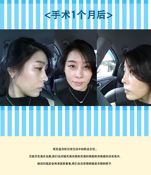分享：女子赴韩整形鼻子修复手术故事