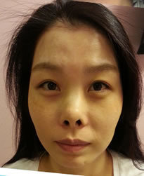 分享：女子赴韩4月31日医院整形鼻修复手术故事