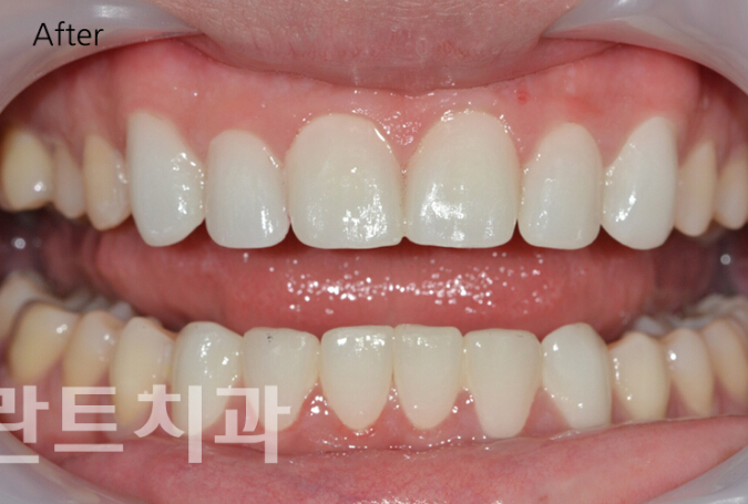 韩国龙plant-牙齿矫正对比日记