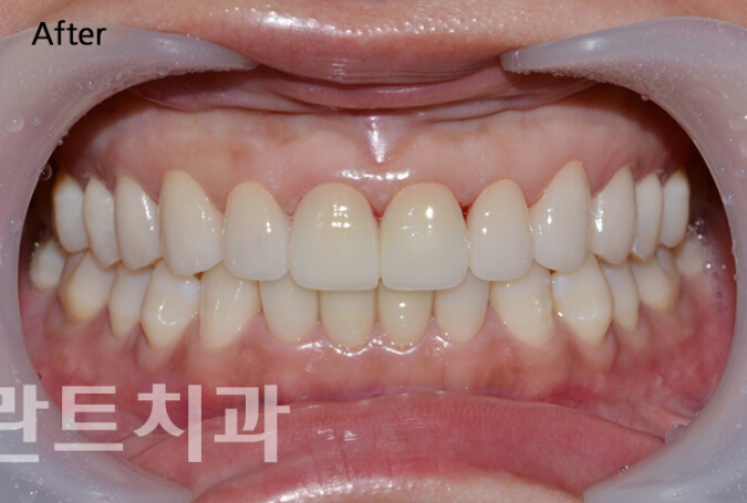 韩国龙plant-牙齿美白对比日记
