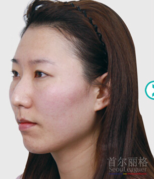 上海首尔丽格-双眼皮+综合隆鼻整形对比案例