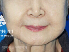 韩国秀美颜医院LEEDS脸部提拉术对比案例