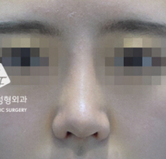 韩国秀美颜整形外科硅胶隆鼻手术对比案例_术后