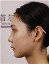 上海首尔丽格-下颌角手术对比案例
