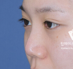 秀美颜整形医院-韩国秀美颜医院鼻部修复整形对比日记