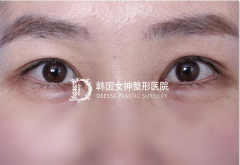 韩国女神整形医院双眼皮+丰卧蚕对比图