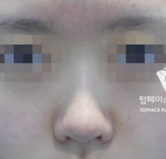 韩国秀美颜整形外科硅胶隆鼻手术对比案例_术前