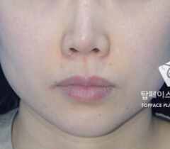 秀美颜整形医院-韩国秀美颜整形外科MINT脸部提拉手术案例