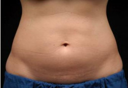 韩国童颜中心腹部溶脂前后对比图