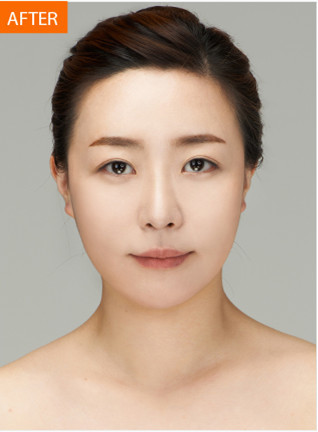 韩国佰诺佰琪医院全脸脂肪移植对比图