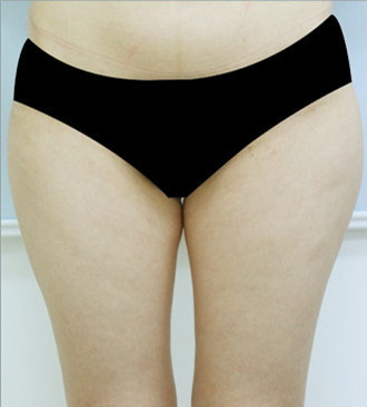 韩国友珍整形-大腿吸脂对比图